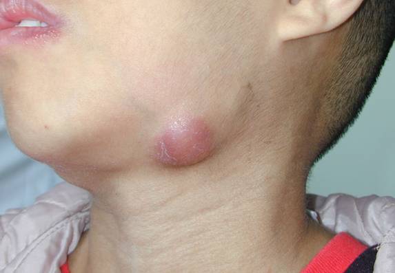 Inflammatory Neck Mass Midwest Sinus And Allergy