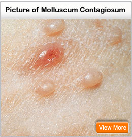 molluscum-contagiosum