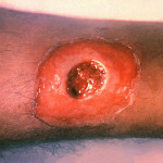 A_diphtheria_skin_lesion_on_the_leg._PHIL_1941_lores