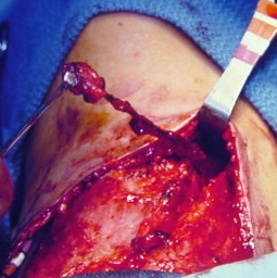 branchial_cleft_sinus_surgery_200x200
