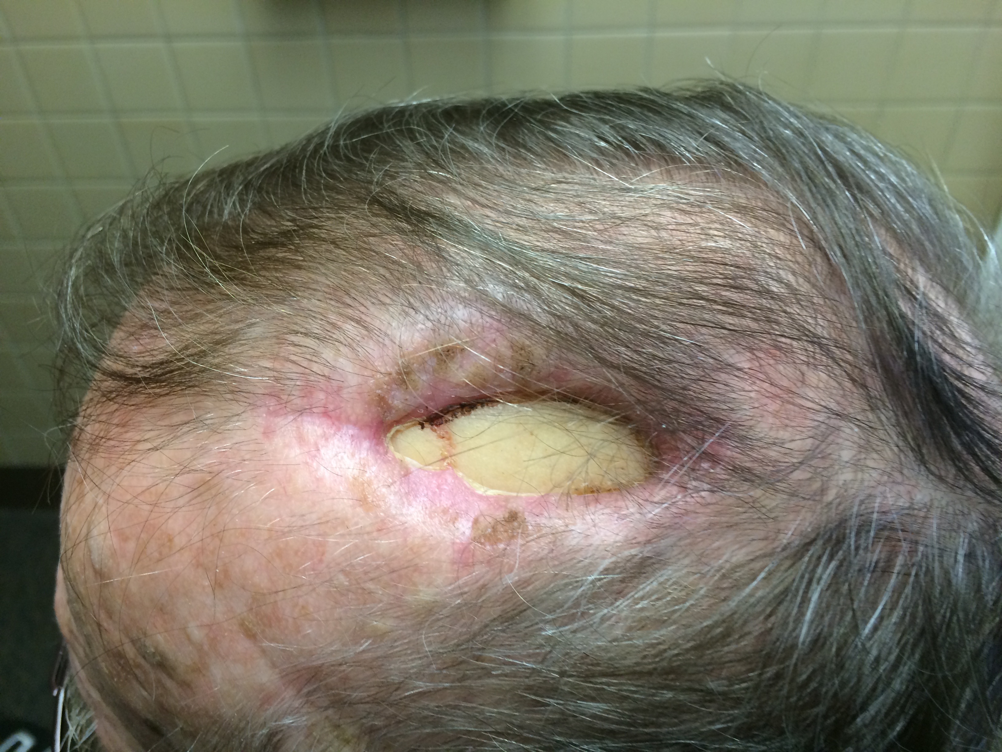 lesions on scalp